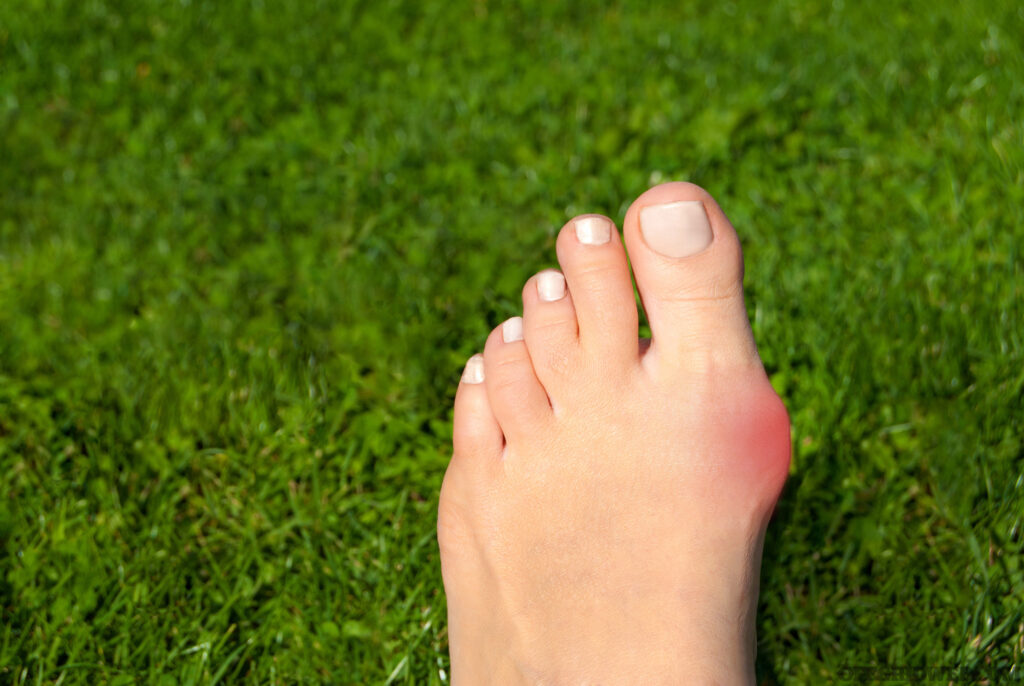 Hallux valgus, bunion in foot on grass background